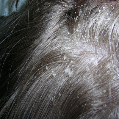 psoriasis dandruff scalp
